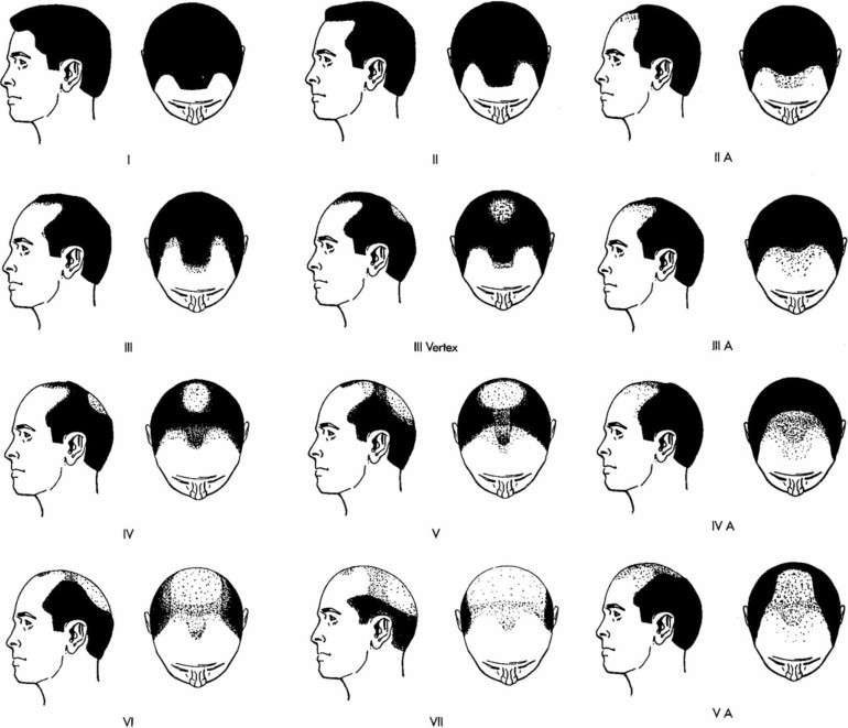 The Norwood Scale can help evaluate different types of hairlines as hair loss progresses.* The Norwood Scale can help evaluate different types of hairlines as hair loss progresses.*