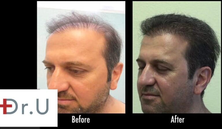 Using a combination of beard and chest hair, Dr. Umar was able to provide the patient with the coverage he wanted. With over 9,000 grafts used to this end, the receding hairline before and after photos depict a satisfied patient with a restored hairline.