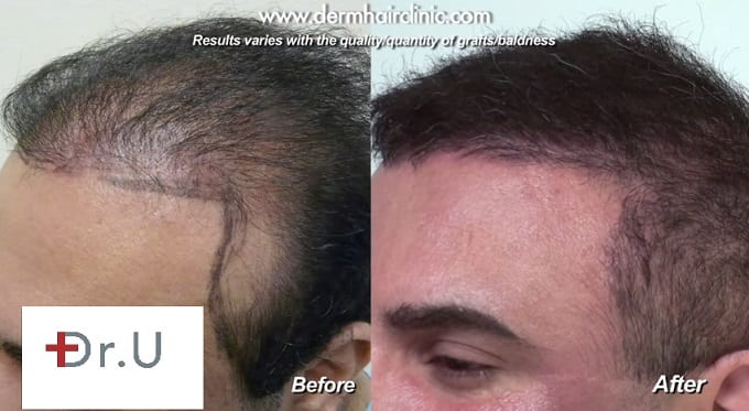 FUE hairline restoration before and after creating natural looking hairlines.* FUE hairline restoration before and after creating natural looking hairlines.*