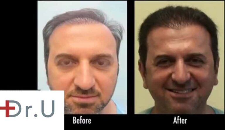 After several botched hair transplants, this patient sought out Dr. Umar for a temple hair restoration. Dr. Umar's advanced FUE Dr.UGraft system allowed him to expand the patient's donor pool in order to create a natural hairline and cover his strip scars.