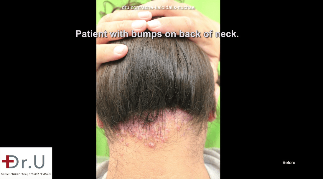 Before his AKN removal operation, the patient suffered AKN pimples on the back of the scalp for 12 years.*