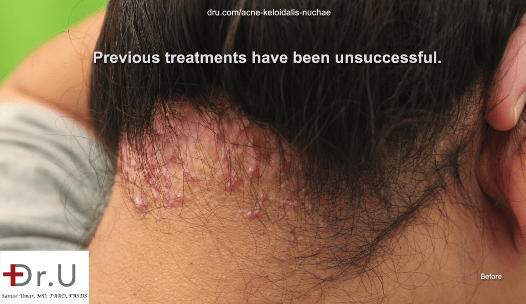 Prior to his AKN removal operation the patient sought help for large bumps at the base of the neck.*