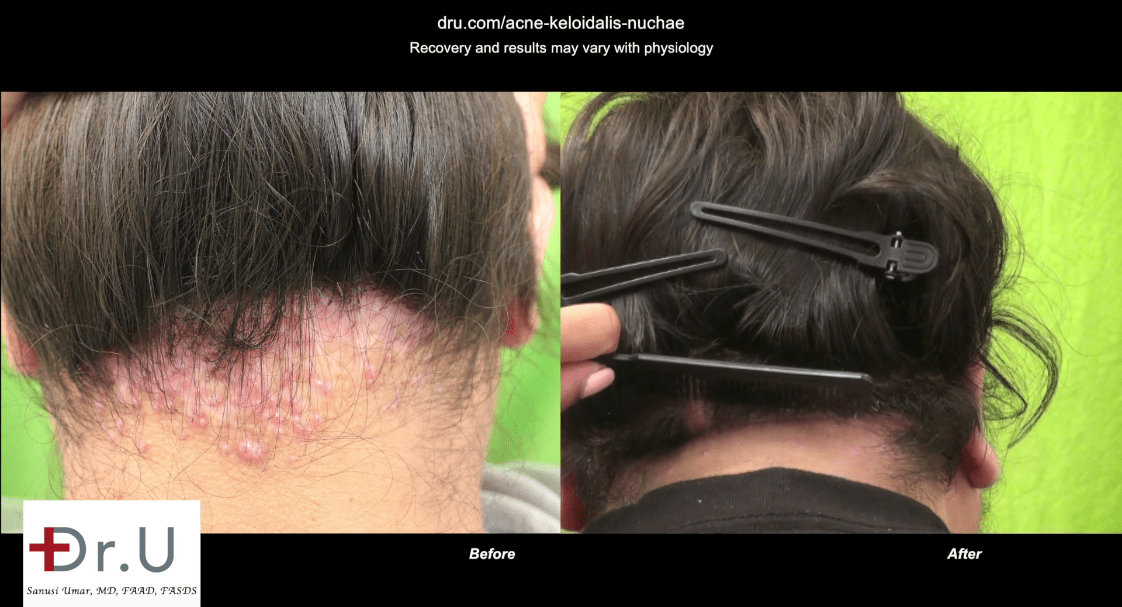 Before and after AKN removal operation; Dr. Umar was the AKN doctor this patient was seeking.*