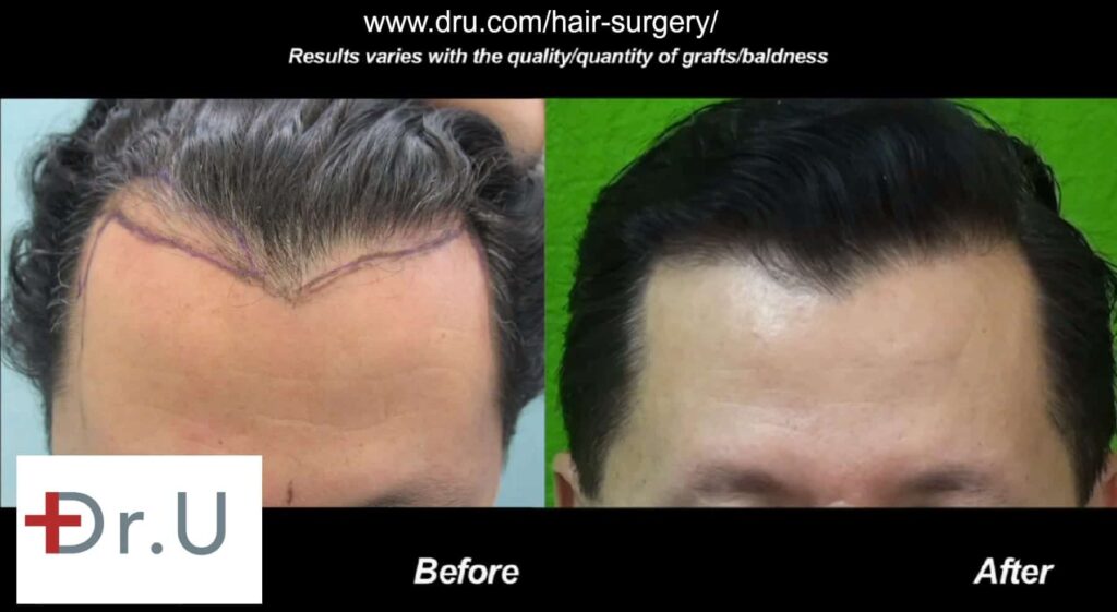 Hairline growth is healthy due to the successful survival of inserted grafts