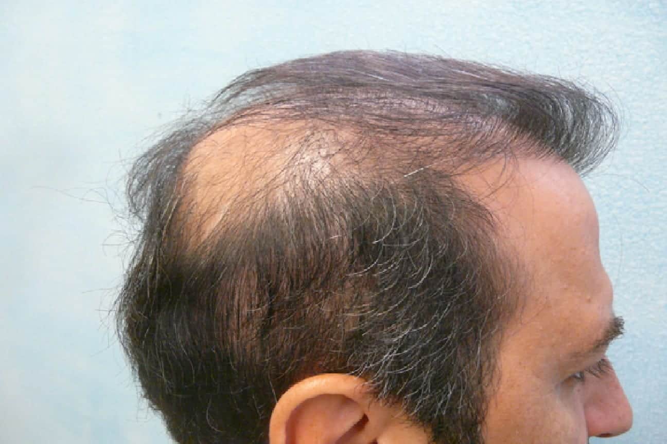 Crown hair loss in males can be addressed through hair transplant surgery. But in this patient's case, the grafts did not survive, leaving him with continued hair loss in the crown