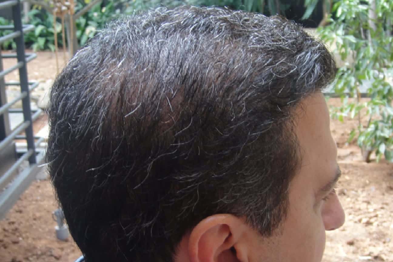 Planning your hair transplant for a successful outcome requires being able to assign an ample graft count as well as having the appropriate tools for safely extracting this donor quantity. 