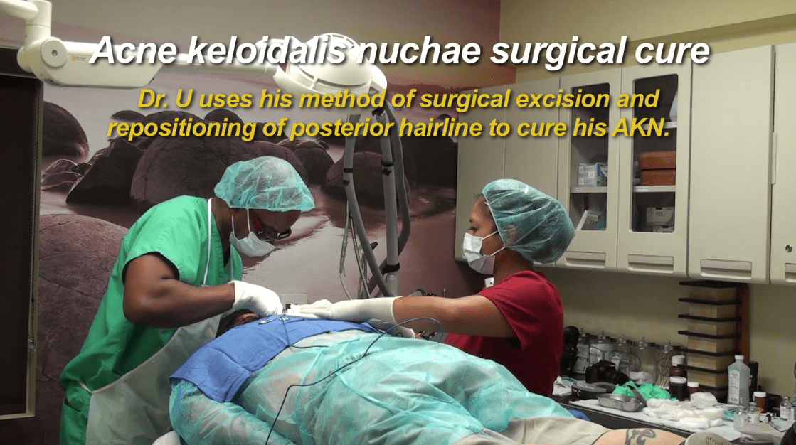 To remove AKN razor bump completely in this Chicago patient,  Dr. Umar would use his singular excision technique