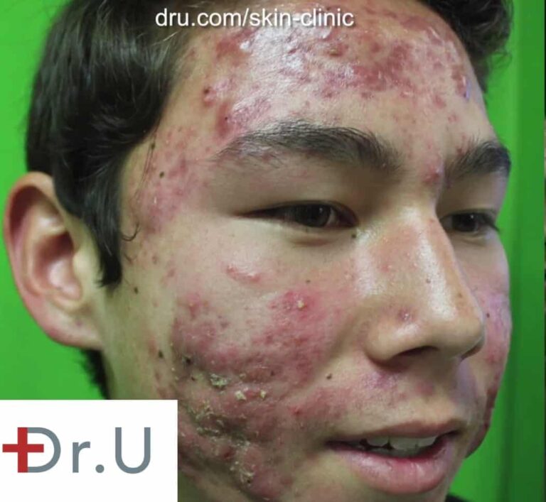 Los Angeles teen seeking an effective cystic acne cure Los Angeles teen seeking treatment for his acne as well as a way to get rid of acne scars.