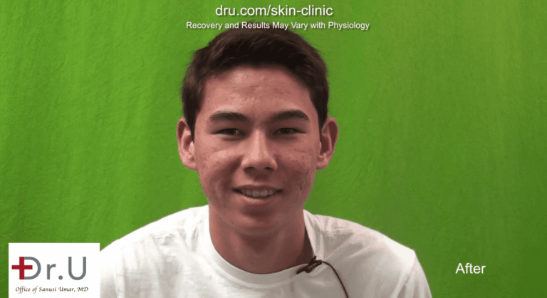 This Los Angeles patient's quest to get rid of acne scars was a success thanks to the two step process that started with photodynamic therapy for acne This Los Angeles patient's quest to get rid of acne scars was a success thanks to the two step process that started with photodynamic therapy for acne