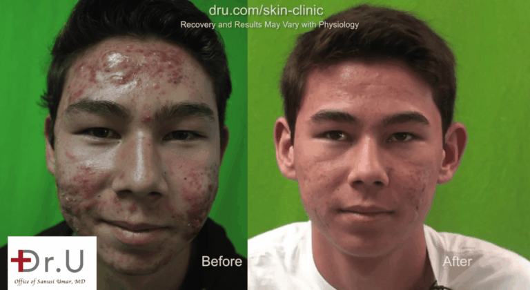Photodynamic acne treatment was an important first step to take before addressing this teen's acne scars Photodynamic acne treatment was an important first step to take before addressing this teen's acne scars