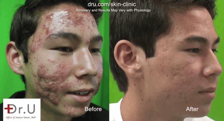 Photodynamic light therapy and laser treatments provided a safe and effective cystic acne cure for this Los Angeles teen Photodynamic light therapy and laser treatments provided a safe and effective cystic acne cure for this Los Angeles teen