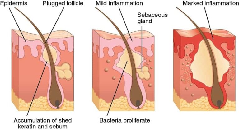 A good treatment for severe acne will address the physiological causes contributing to the condition, such as bacteria and the inflammation that follows. A good treatment for severe acne will address the physiological causes contributing to the condition, such as bacteria and the inflammation that follows.
