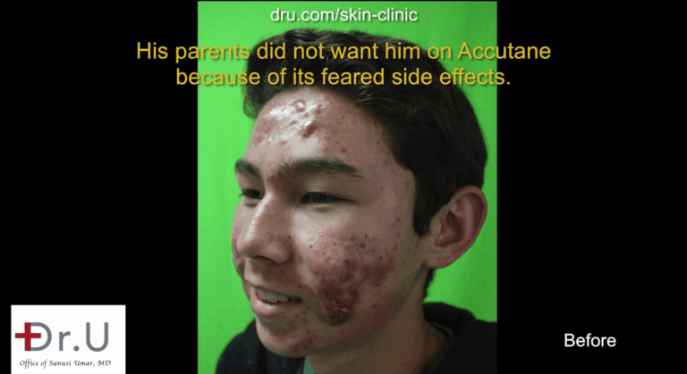 Patient's parents wanted to find a safe accutane alternative for their son's severe acne, so they looked for a photodynamic acne treatment in Los Angeles. Patient's parents wanted to find a safe accutane alternative for their son's severe acne, so they looked for a photodynamic acne treatment in Los Angeles.