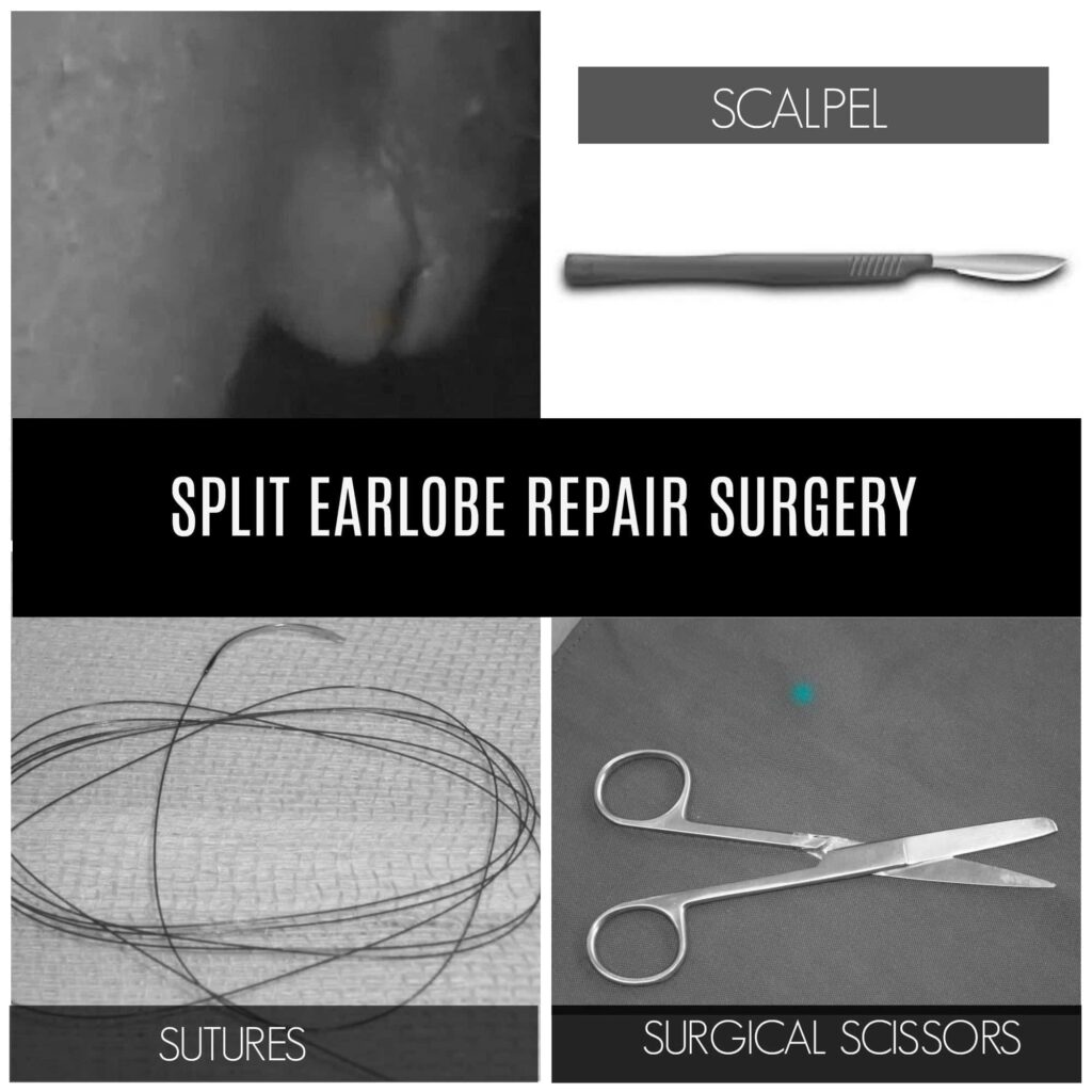 Pictured above is another patient example of a split earlobe prior to treatment, and the typical tools Dr. U uses in order to repair the earlobe. 