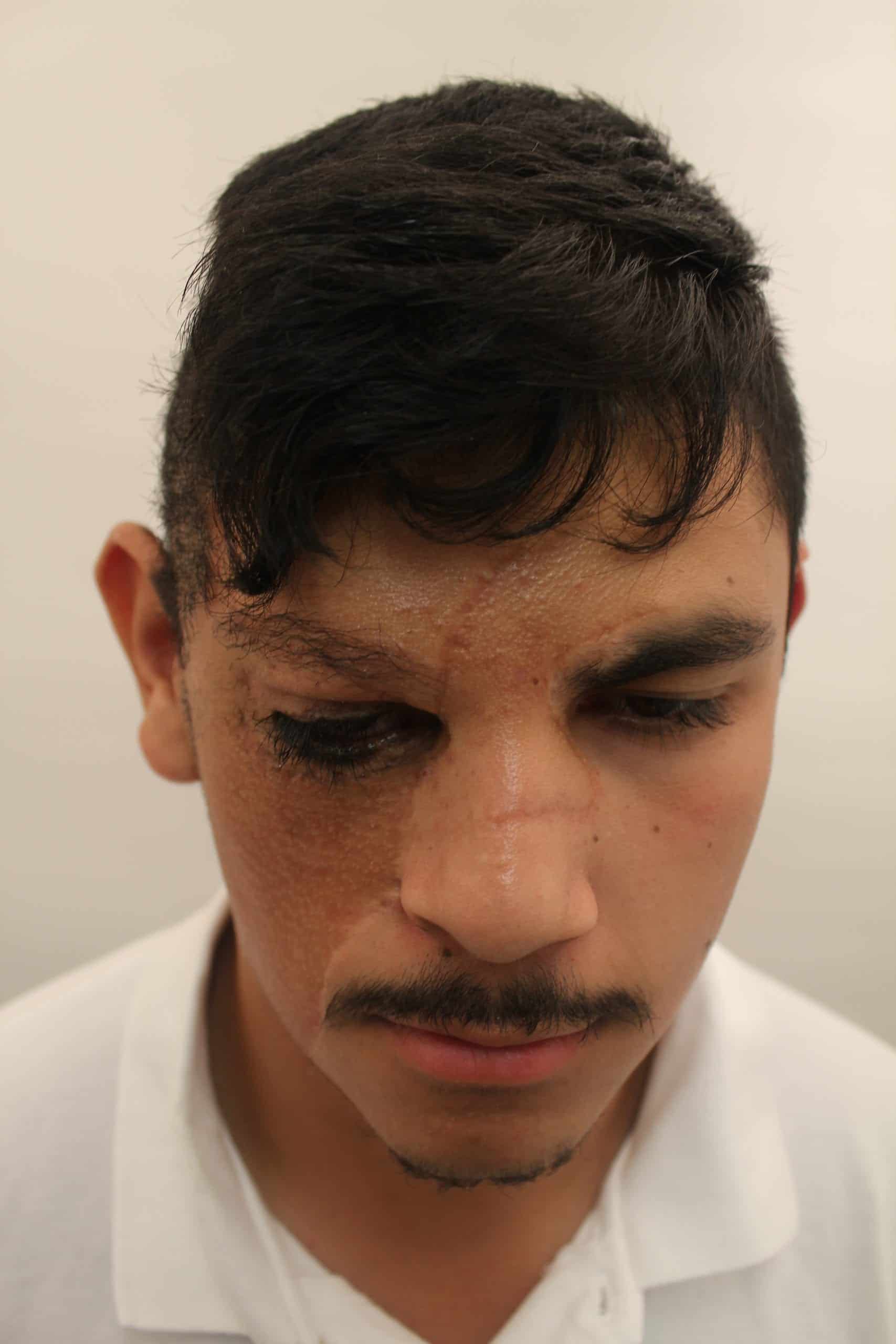 Dr. Umar's eyebrow hair transplant surgery with leg hair grafts achieved a new brow that is symmetrical with the left in terms of length, shape and hair growth detail