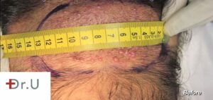 Measuring region of pimples on the back of the scalp prior to AKN removal operation