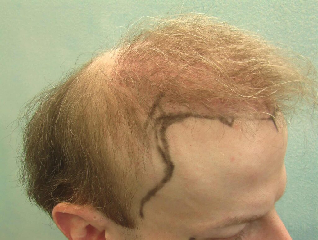 This patient sought a temple hair restoration after experiencing severe temple hair loss, so he consulted with Dr. U about his options.