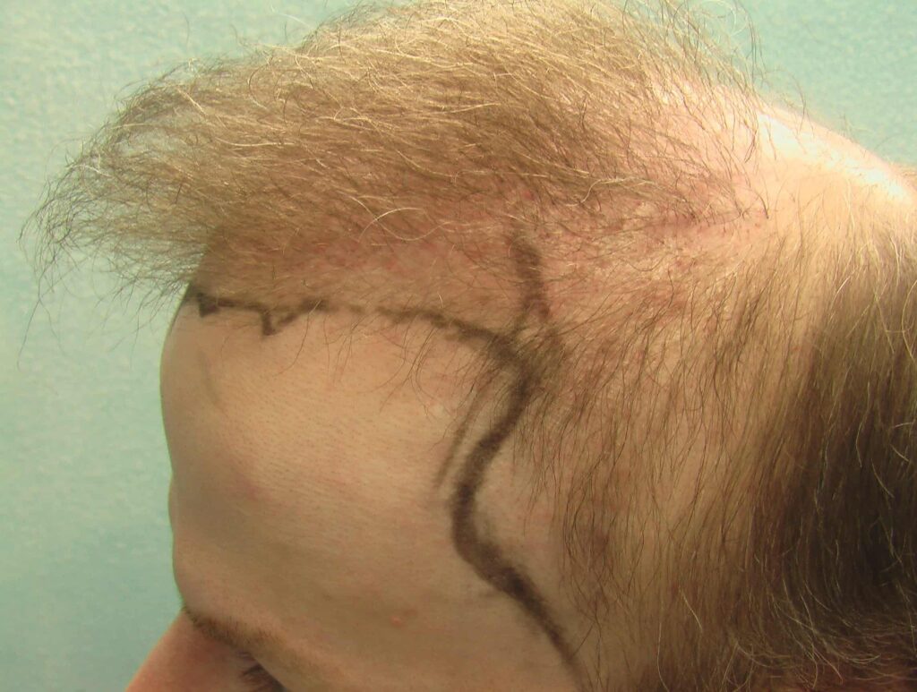 This patient was unhappy with his temple hair loss, so he consulted with Dr. U about a temple hair transplant. Dr. U developed a unique course of action to meet the patient's desired results with his advanced FUE Dr.UGraft procedure.
