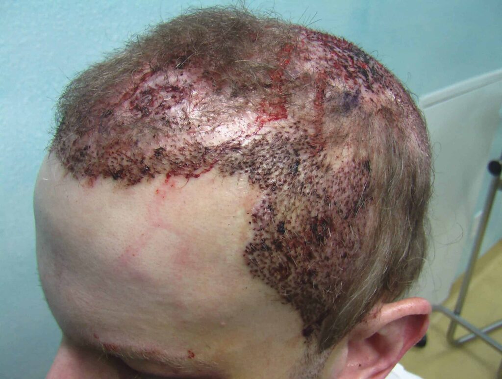 With the Dr.UGraft™ procedure, Dr. U was able to complete the temple hair transplant by extracting hair from the beard and chest in order to create a natural hairline and temple points.