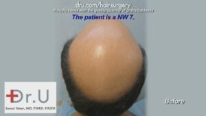 Norwood 7 Baldness - High Graft Count