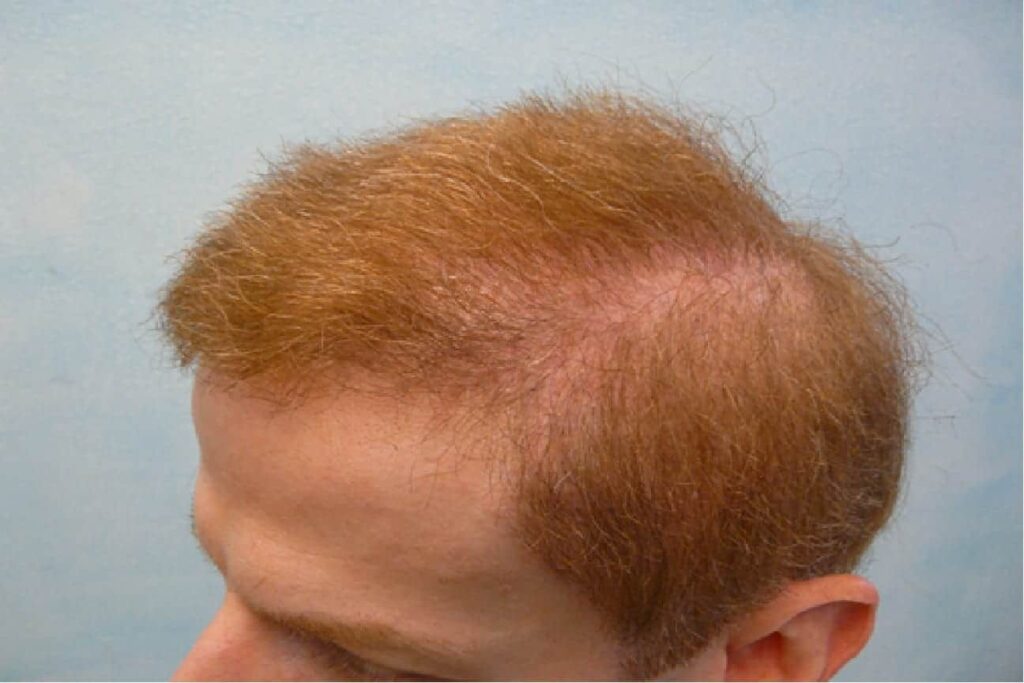 The patient was pleased with the results of his temple hair transplant. The advanced FUE Dr.UPunch Rotor™ was able to extract thousands of grafts from the patient's beard and chest donor areas, providing the patient with the grafts needed to produce the best results.