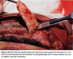Removal of strip from the safe donor zone on the back of the patient's head during Follicular Unit Strip Surgery (FUSS), also known as FUT (Follicular Unit Transfer) or FUHT (Follicular Unit Hair Transplant)