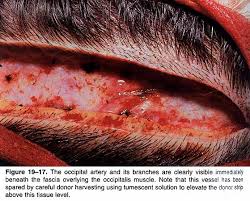Photo showing the open wound that remains after the removal of the strip, during an FUSS procedure. 