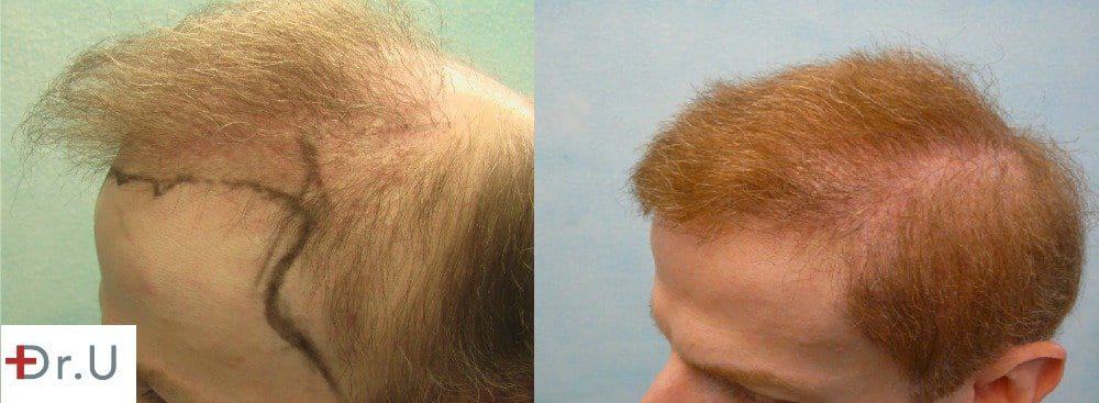 Temple Reconstruction For Hair Transplant Repair Patient