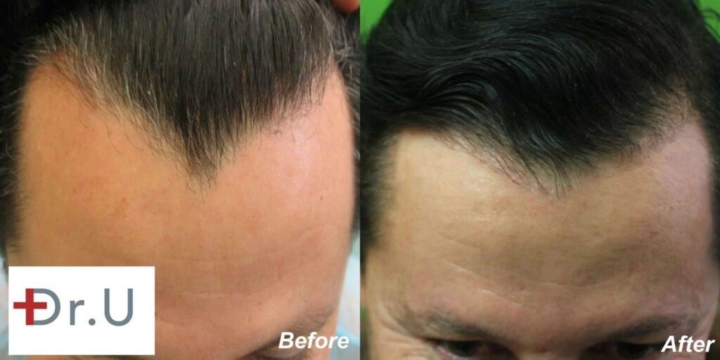 Dr. U extracted nape hair for this patient's hairline reconstruction in order to soften the harsh angular lines for a more youthful look.