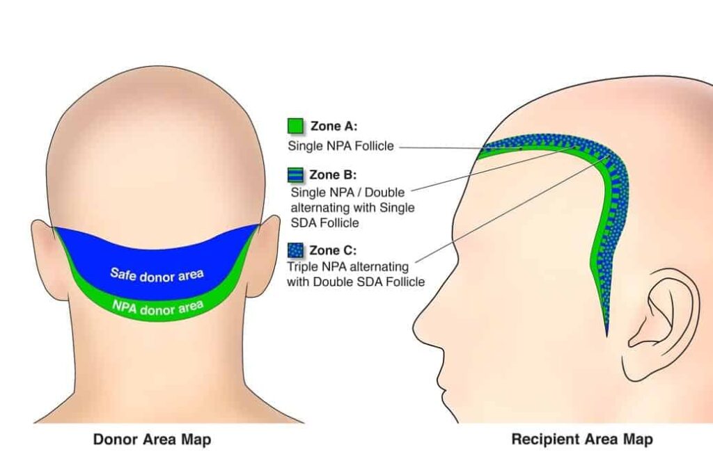 In more conventional hairline reconstruction surgeries, only hair from the safe donor area (SDA) is used due to the fear that nape and preauricular hair is not permanent. However, Dr. Umar's FUE Shave Test can determine whether patients qualify for a nape hair-based hairline.