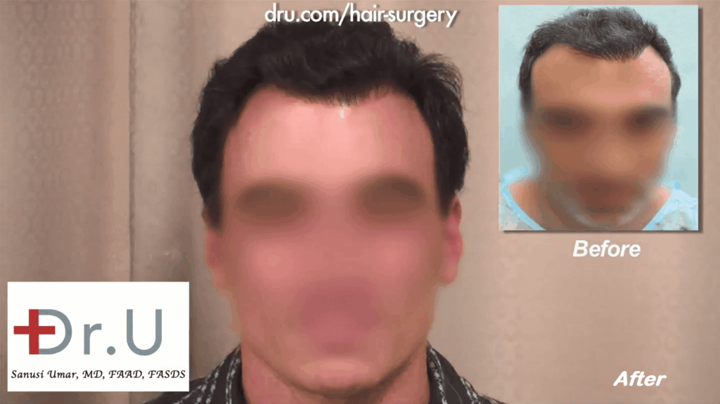 Using the Dr.UGraft advanced FUE system, Dr. U was able to correct this patient's bad hairline with the use of nape and head hairs, creating a softer, more natural appearance that compliments the patient's facial structure.