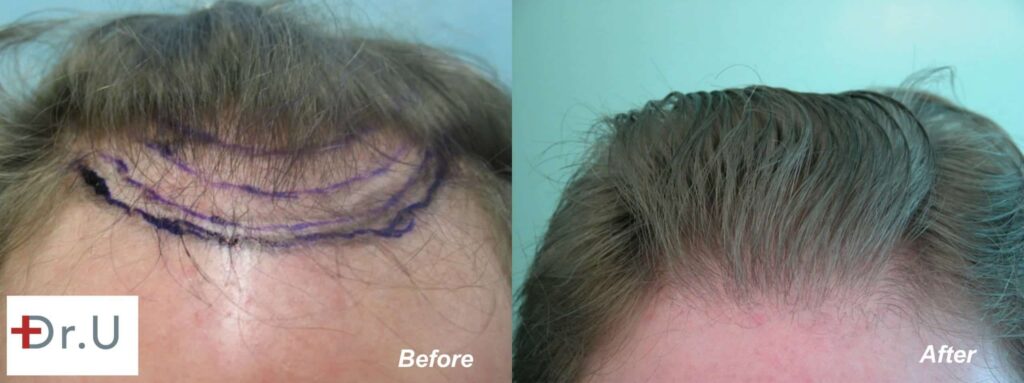 Nape hair was used to create a softer, natural looking hairline and temple points for this patient.