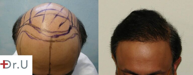 This severely bald, Norwood 7 patient was able to achieve comprehensive coverage for both the hairline and the crown due to the use of body hair grafts harvested with the Dr.UPunch intelligent 