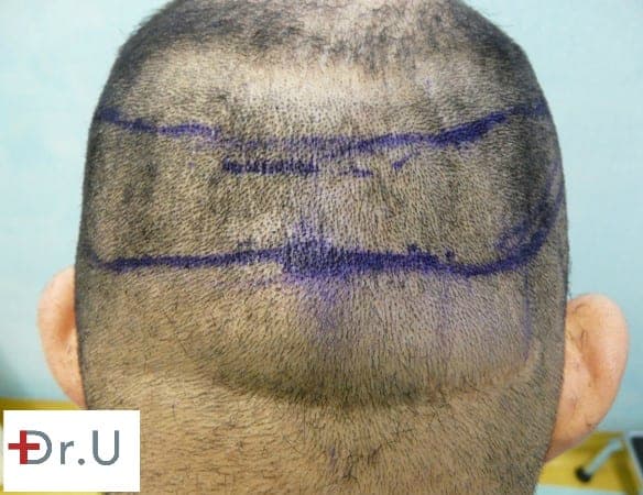 A line of demarcation can be seen between the SDA and the nape, which means that nape hairs would not survive long term in an FUE hairline surgery in this patient's case.