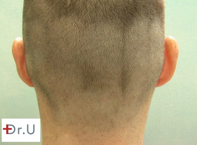 Dr. U uses his FUE Shave Test to determine whether or not a patient is a good candidate for a FUE hairline surgery using nape hair.