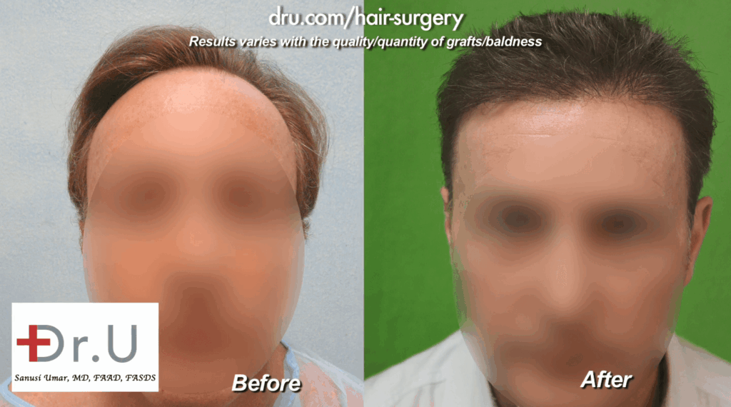 Using the Dr. UPunch Rotor™, Dr. Umar sucessfully extracted 3,500 grafts from the head and nape, which he then used to construct a more youthful, natural looking hairline with carefully positioned and angled temple points to suit the patient's facial structure.