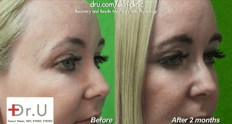 Botox was used as a crows feet treatment to improve the appearance of minor lines around the patient's eyes and to prevent existing wrinkles in this area from becoming deeper Botox was used as a crows feet treatment to improve the appearance of minor lines around the patient's eyes and to prevent existing wrinkles in this area from becoming deeper