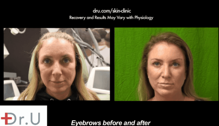 As neuromuscular injections, Botox Dysport and Xeomin can relax a certain set of eyebrow muscles in order to activate the opposite pair. Botox was used in this fashion to raise this patient's droopy brows As neuromuscular injections, Botox Dysport and Xeomin can relax a certain set of eyebrow muscles in order to activate the opposite pair. Botox was used in this fashion to raise this patient's droopy brows