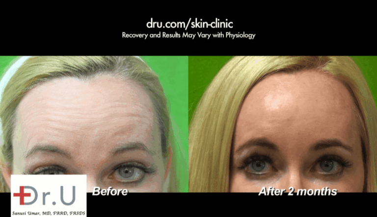 Botox, Dysport and Xeomin can all be considered for treating horizontal forehead creases. For this particular patient, Botox was used to relax the muscles responsible for these wrinkles. Botox, Dysport and Xeomin can all be considered for treating horizontal forehead creases. For this particular patient, Botox was used to relax the muscles responsible for these wrinkles.