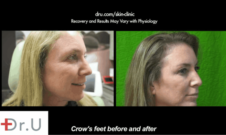 This patient of Dr. Umar benefited from the use of Botox as a crows feet treatment which drastically reduced the appearance of creases in this area, even when her face is at rest This patient of Dr. Umar benefited from the use of Botox as a crows feet treatment which drastically reduced the appearance of creases in this area, even when her face is at rest
