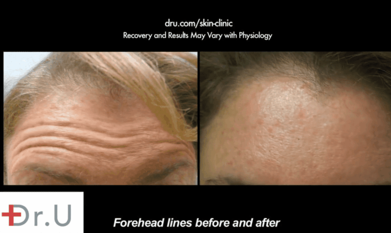 Dr. Umar used Botox to help this patient achieve a smoother, tighter, more youthful looking forehead. This is notably shown in these side by side comparison photos Dr. Umar used Botox to help this patient achieve a smoother, tighter, more youthful looking forehead. This is notably shown in these side by side comparison photos