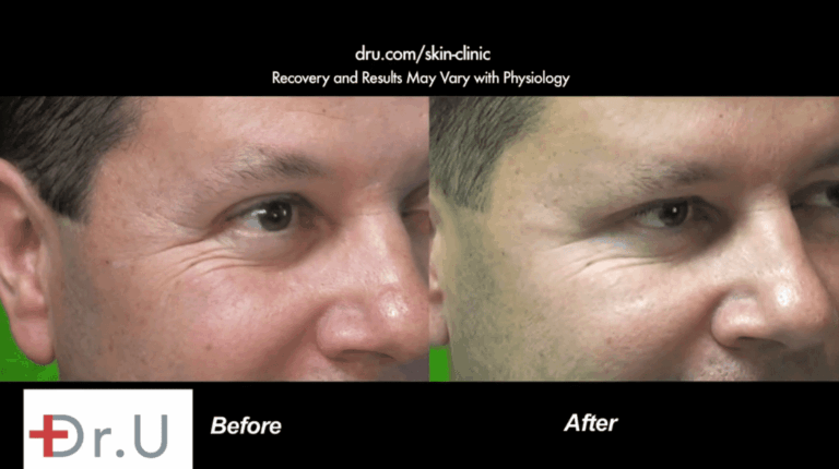 This male patient's crows feet treatment using Dysport helped reduce the number of branching lines around the outer corners of his eyes This male patient's crows feet treatment using Dysport helped reduce the number of branching lines around the outer corners of his eyes