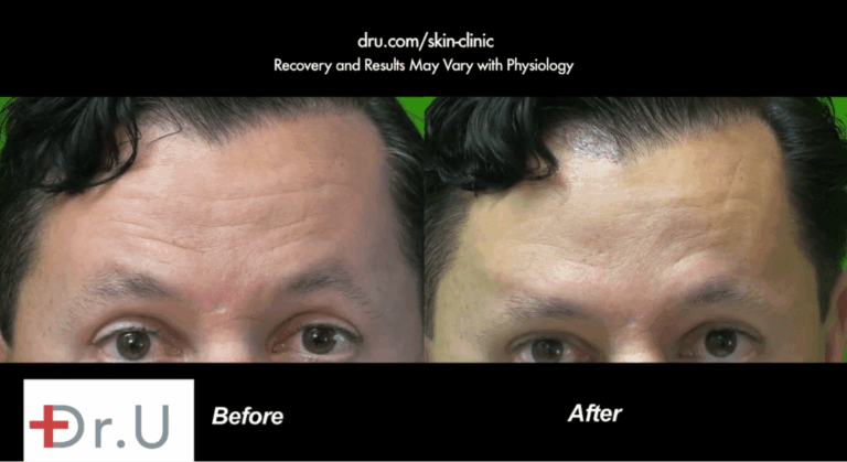 Dysport was used to improve the appearance of forehead lines on this patient's forehead. These before and after photos show a fewer number of wrinkles and a smoother looking forehead Dysport was used to improve the appearance of forehead lines on this patient's forehead. These before and after photos show a fewer number of wrinkles and a smoother looking forehead