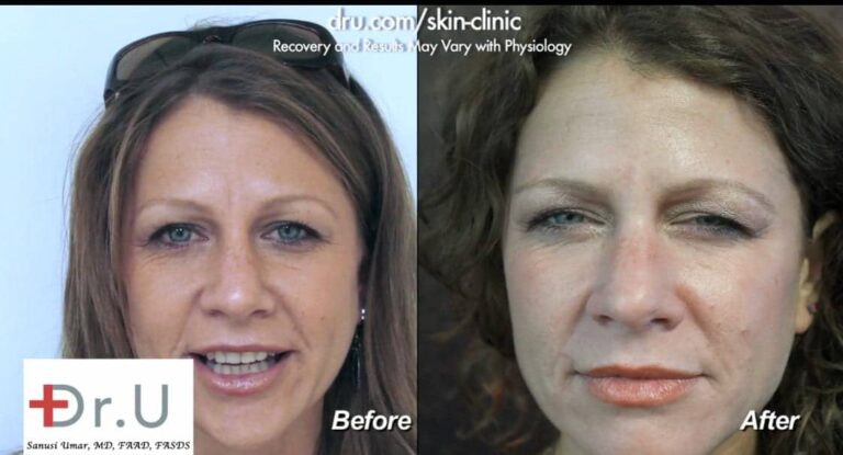 Dysport was used as a treatment to help get rid of a single frown line groove in between the patient's eyebrows. The line is much softer following her procedure even when her face is stationary Dysport was used as a treatment to help get rid of a single frown line groove in between the patient's eyebrows. The line is much softer following her procedure even when her face is stationary