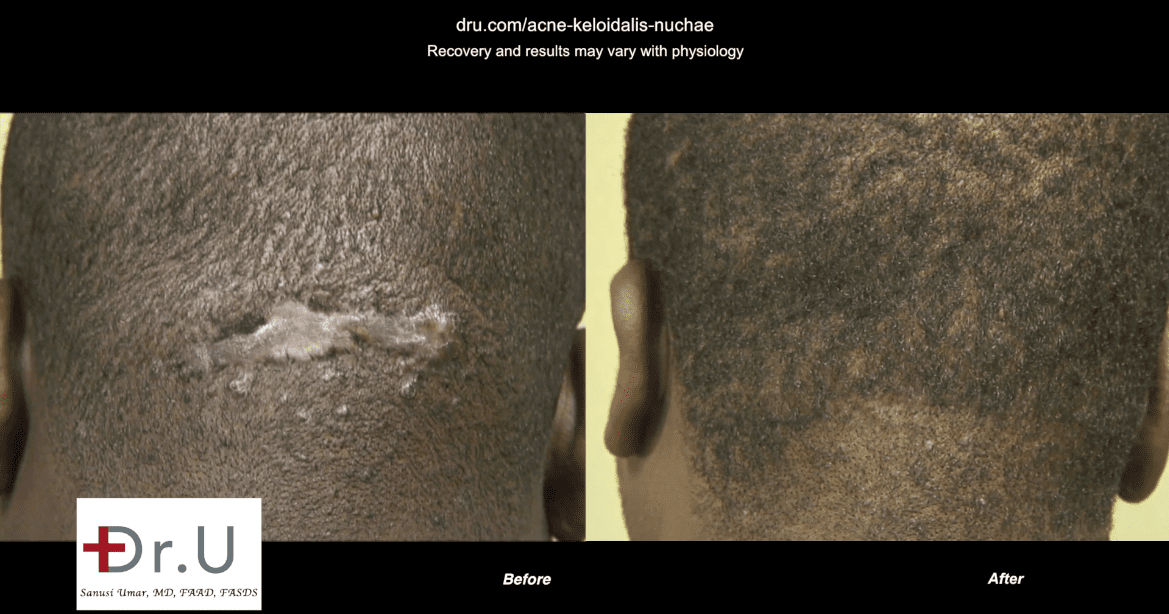 Dr. U Skin Clinic makes it possible to remove large razor bump growth on the back of the neck.*