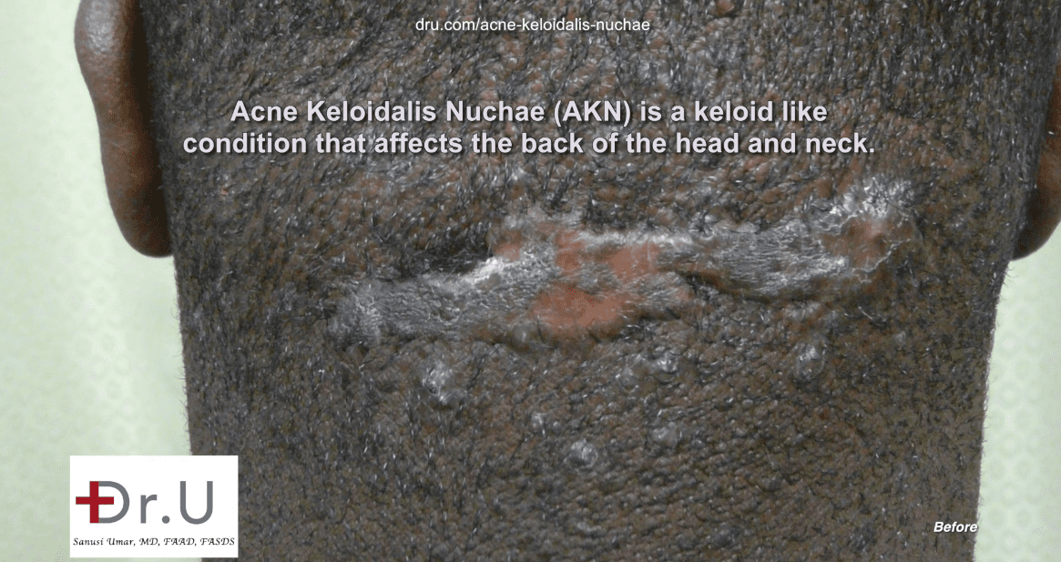 Surgical removal of AKN lump would be necessary after steroid injections failed.*