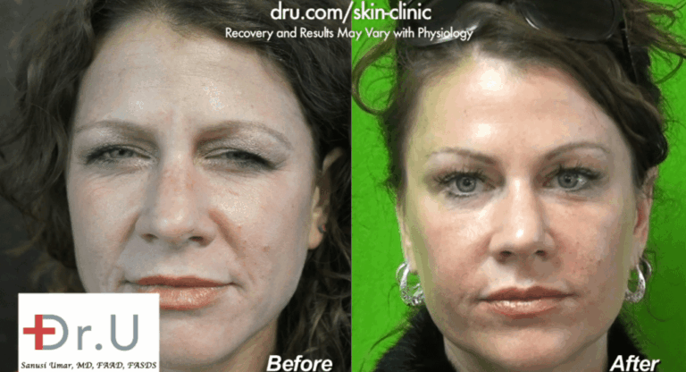 Redondo Beach patient is pleased with her natural looking lip augmentation outcome. This was achieved through a conservative use of filler and the thoughtful placement of the injections