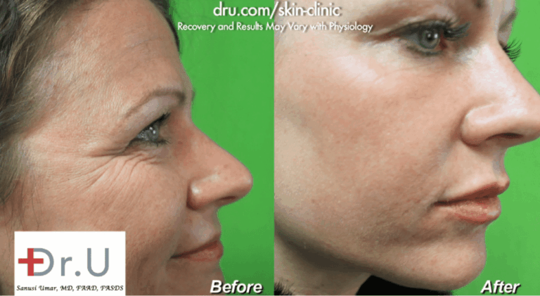 The balanced application of products like Juvederm is key to the question of how to avoid duck lips with fillers