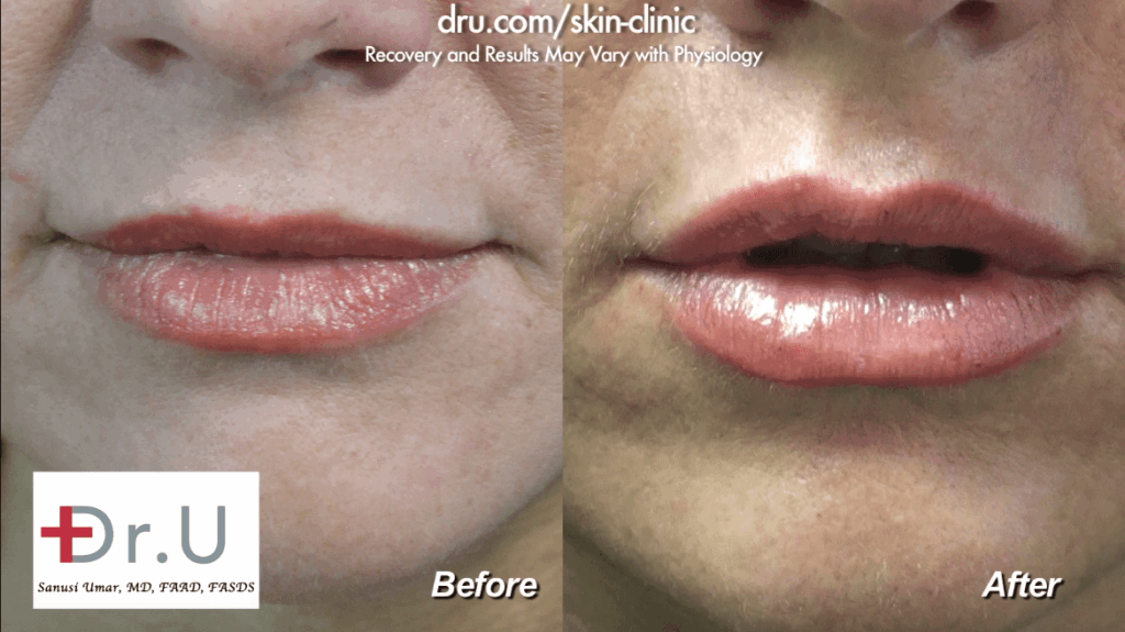 Before and after photos of a lip augmentation for the cupid's bow