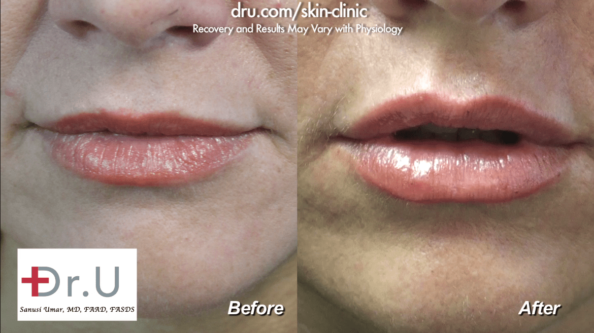 How to avoid duck lips with fillers? Beautiful, natural looking volume through lip augmentation at Dr. U Skin Clinic.*